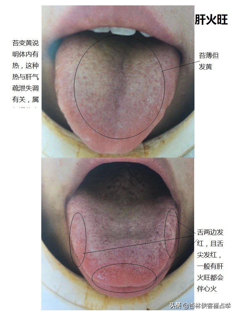 心肝火旺怎么调，送你一个方子，疏肝理气，滋阴清热，健脾祛湿