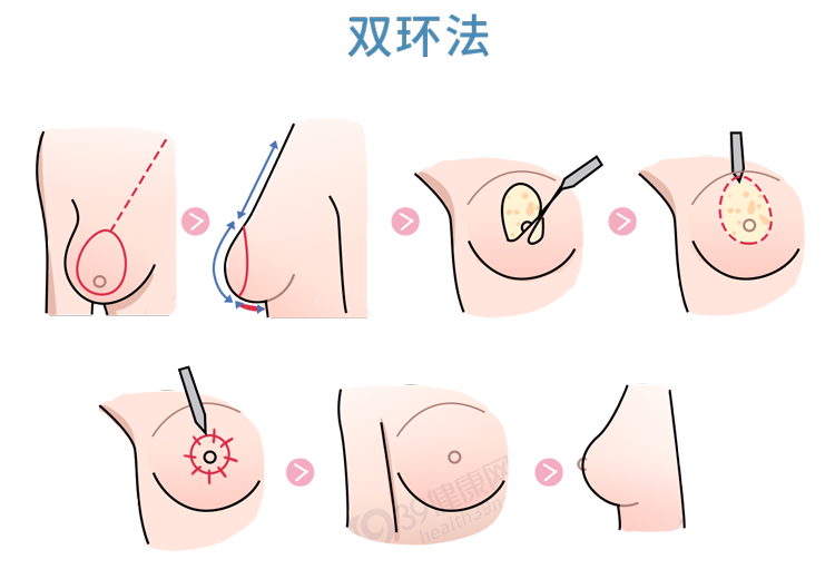 被“巨乳症”折磨的女生，有苦说不出：就像胸前挂着11瓶矿泉水