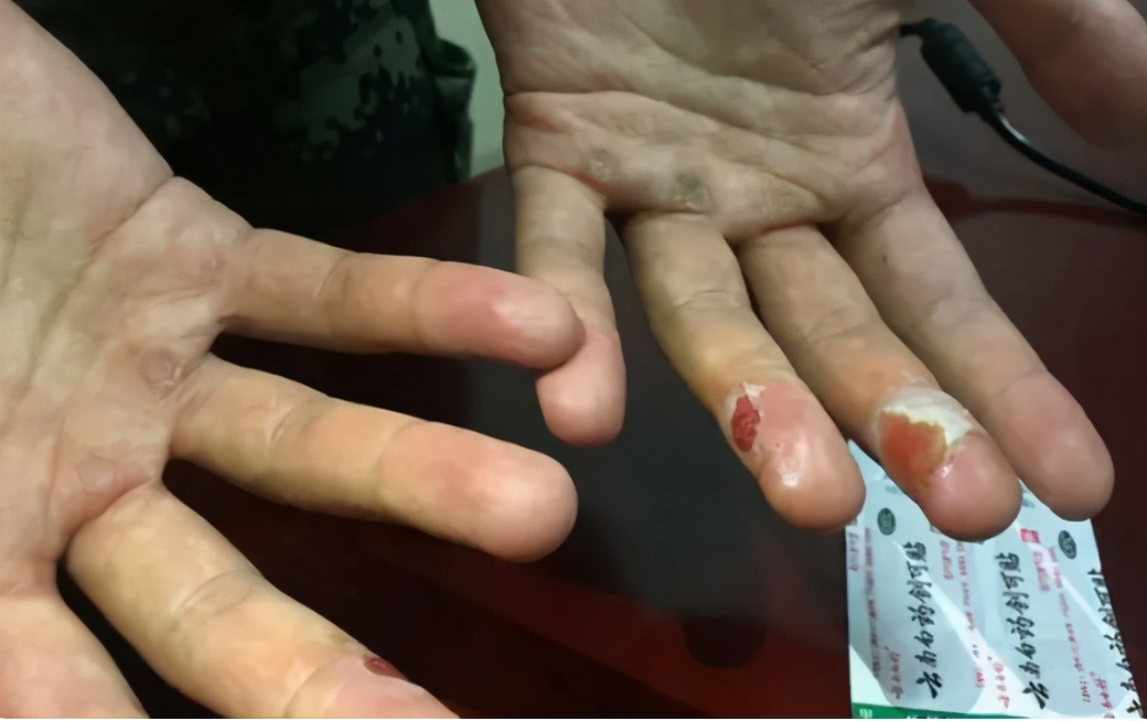 云南考生高考713分，被清华录取却哭了，看到他的手恍然大悟