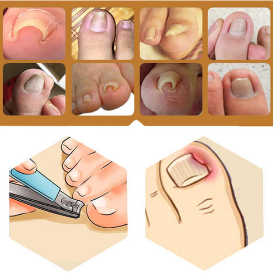 脚趾甲总往肉里长，得了“嵌甲”怎么办？医生：2个方法很管用