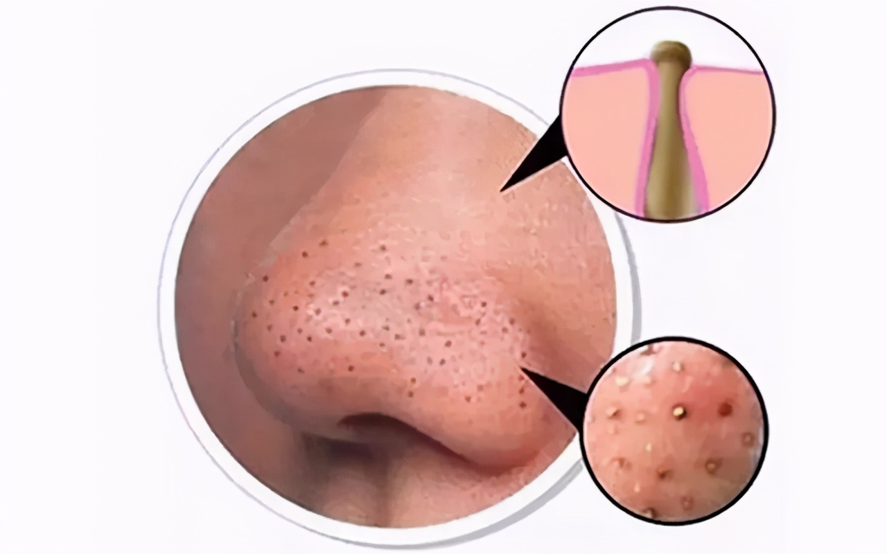 男士毛孔堵塞是因为油脂分泌旺盛或毛囊角化,皮下组织细胞死亡,脱落