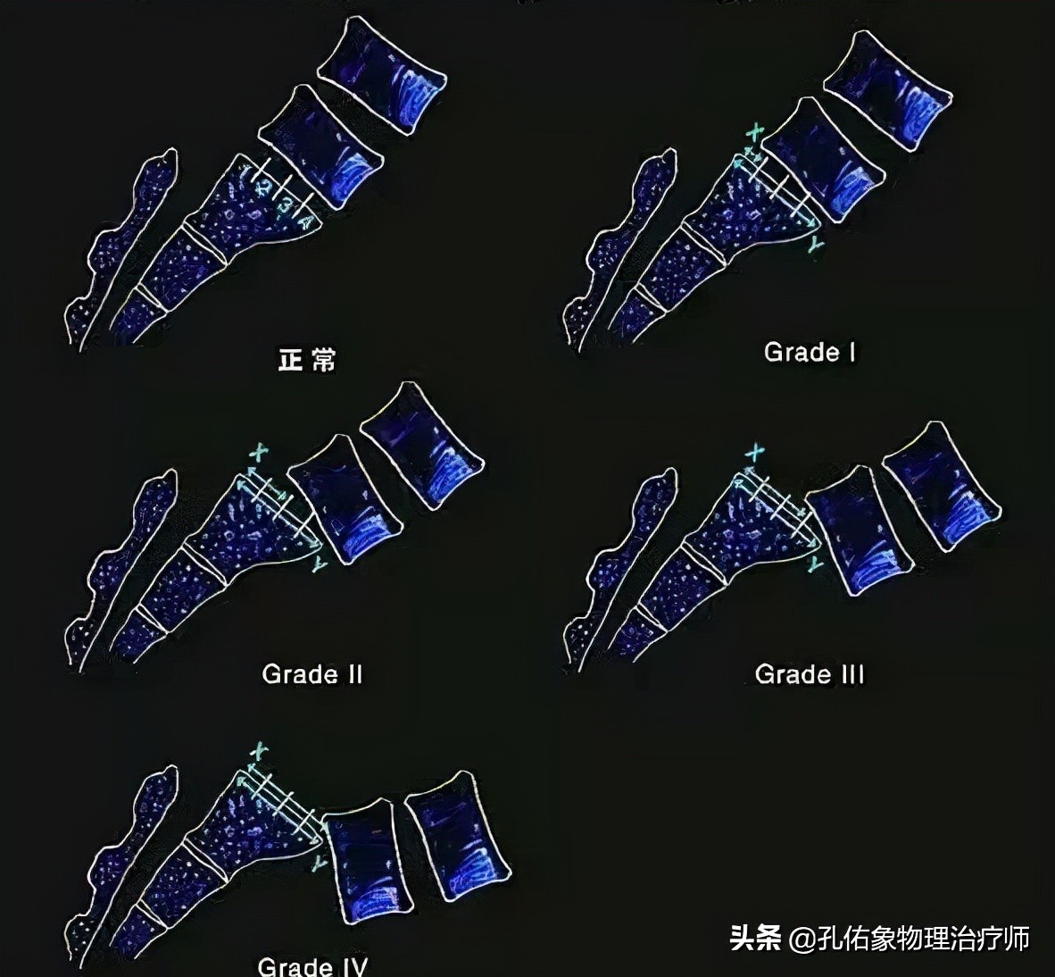 腰臀部疼或下肢麻木，是腰椎间盘突出吗？9种疾病需鉴别