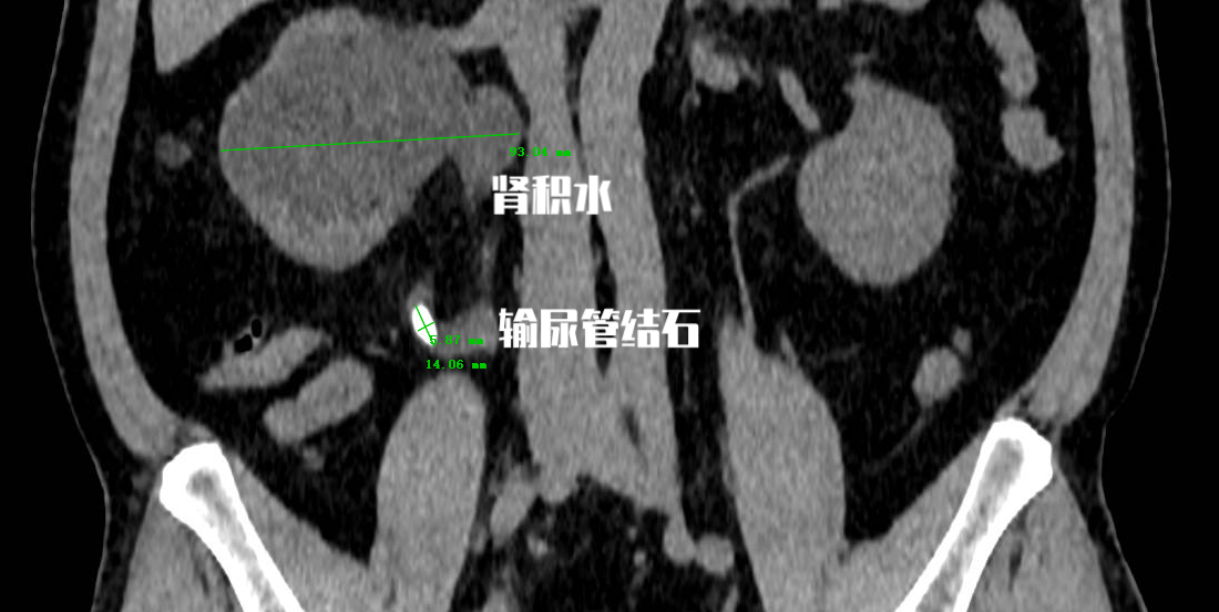 疼是输尿管结石治疗的原因吗？不疼就不治，这种想法很要命