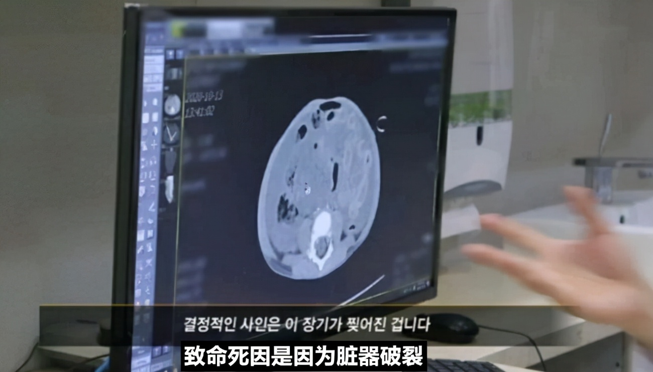 被领养8个月后，她被养父母活活虐死，肠破骨碎，韩国郑仁案始末