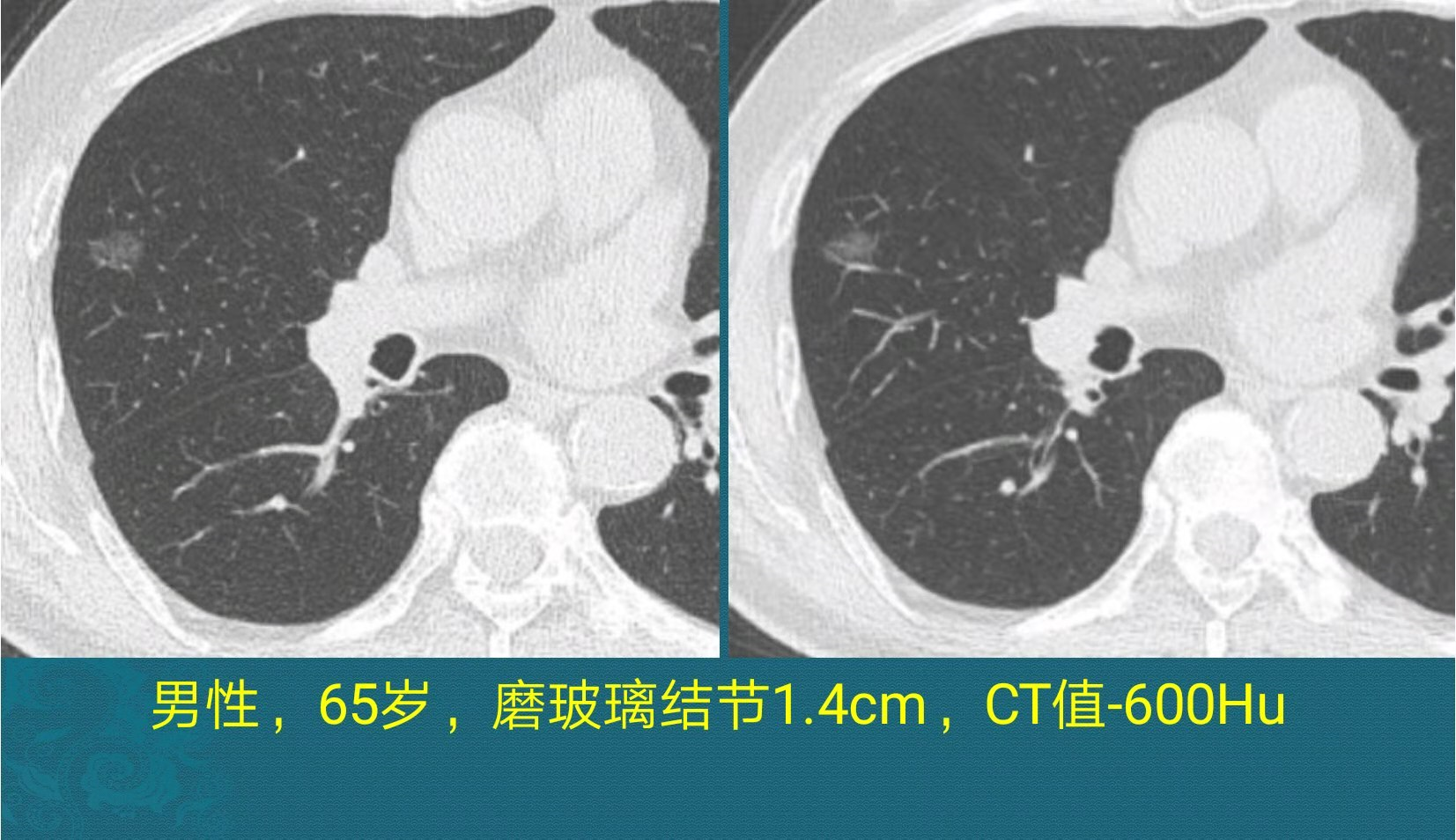 闢謠:ct報告中的