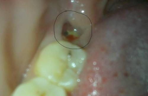 智齿拔除之后有牙洞该怎么办？又该注意哪些事项？