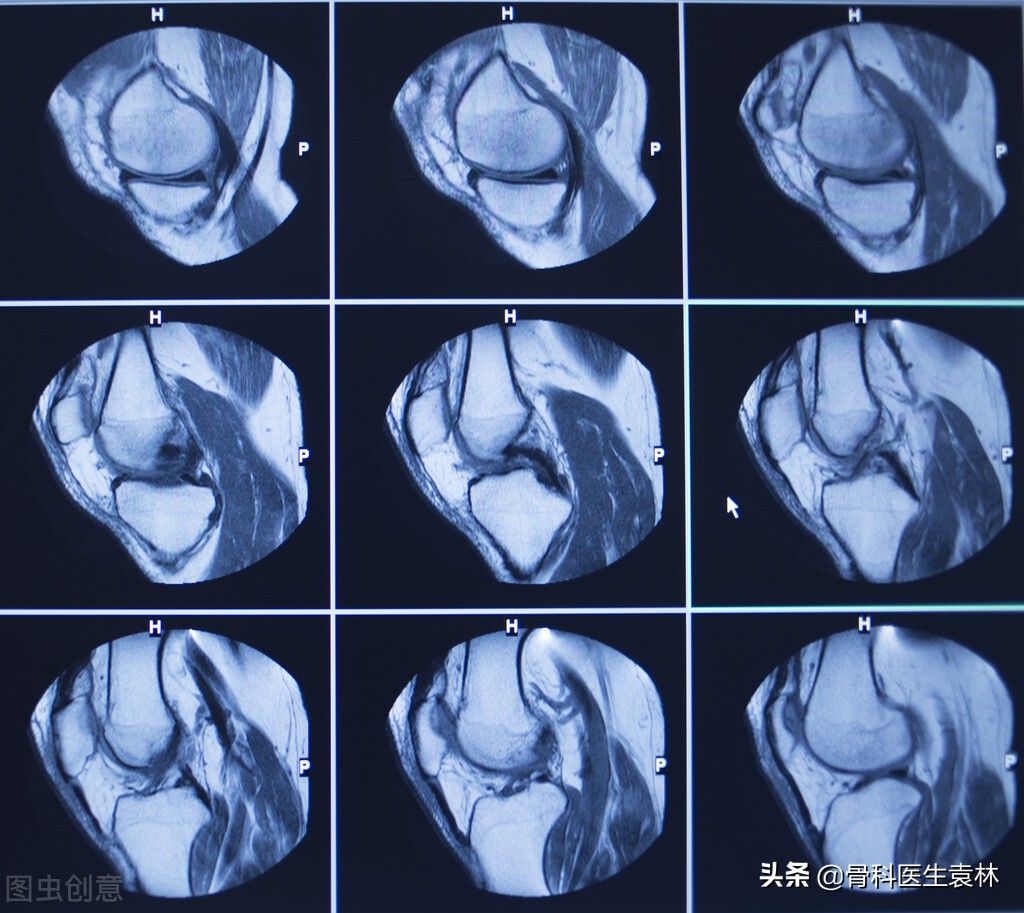 半月板损伤是怎么回事？半月板那点事你知道多少？