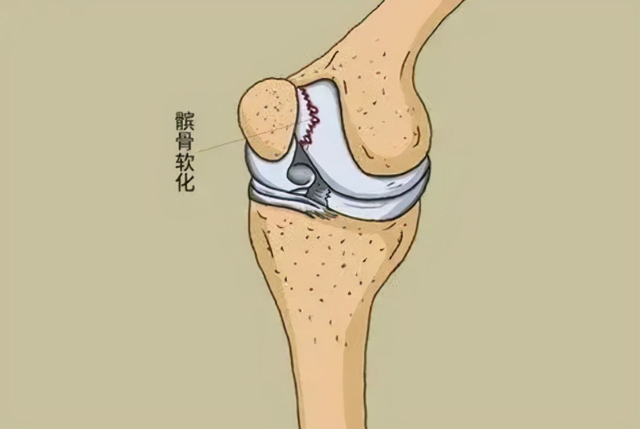 走路时，膝盖突然“软”一下，是咋回事？要警惕这几种情况