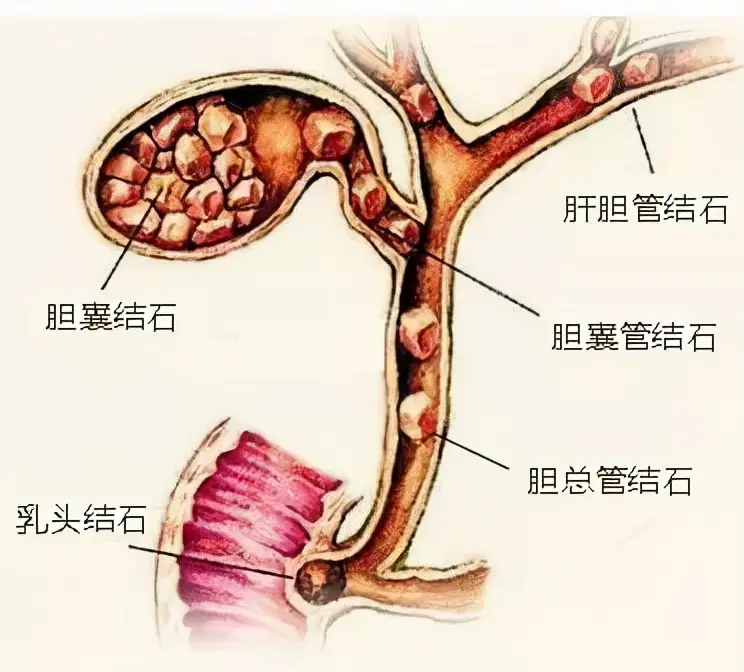 肝内胆管结石严重吗（肝内胆管结石怎么引起的）