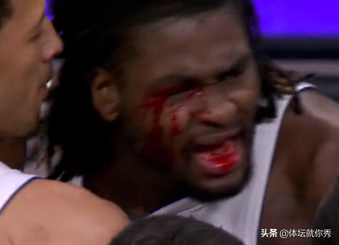 nba中为什么打到眉骨会流血(火爆冲突！眉骨被打出血，20岁壮汉怒喷詹姆斯，场面3次险些失控)