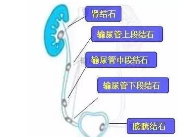 肾积水就代表有结石吗？彩超医生告诉你这其中的逻辑关系