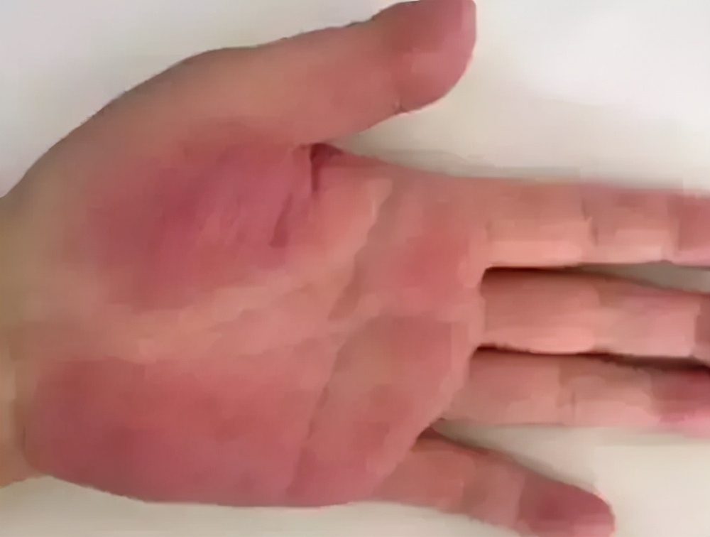 手上有这五个信号，警惕是肝脏亮红灯了