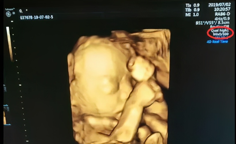 三个月胎儿四维彩超图片