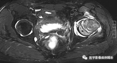 垂体柄阻断综合征并股骨头骨骺滑脱MR典型影像表现及分析思路