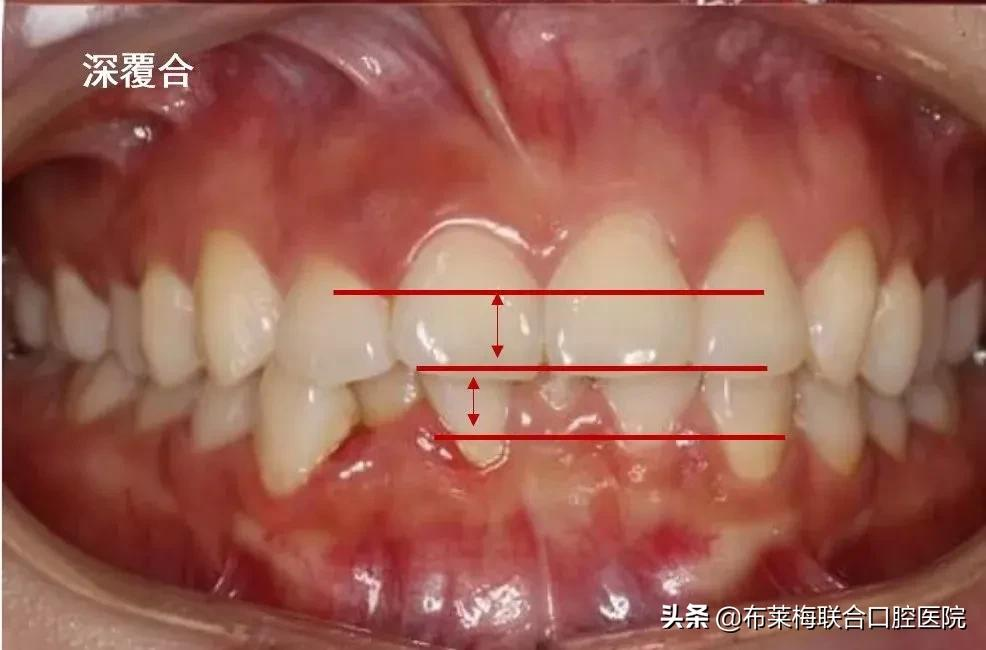 牙齿矫正,你所关心的那些问题