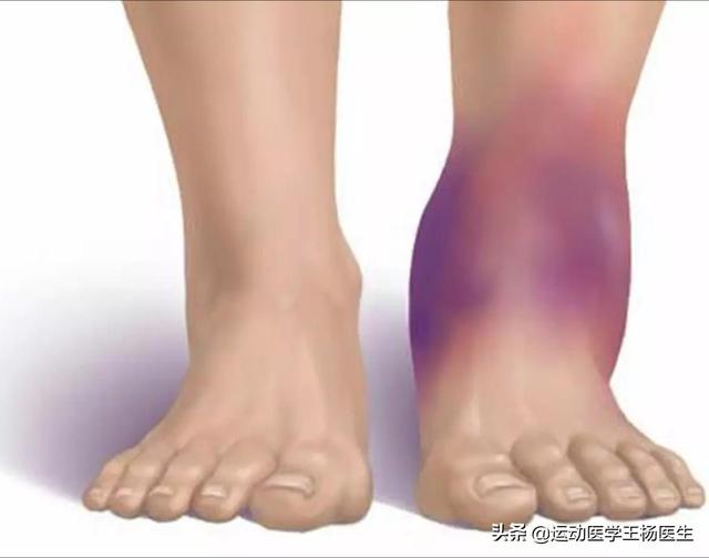 脚踝扭伤肿痛应急处理方法