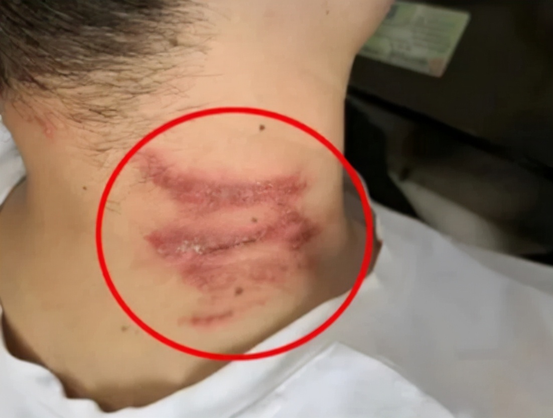 被隐翅虫咬伤急救指南,毒液酸性或可堪比硫酸?