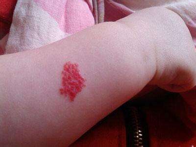 没满月发现手上长"草莓",皮肤科医生:胎记