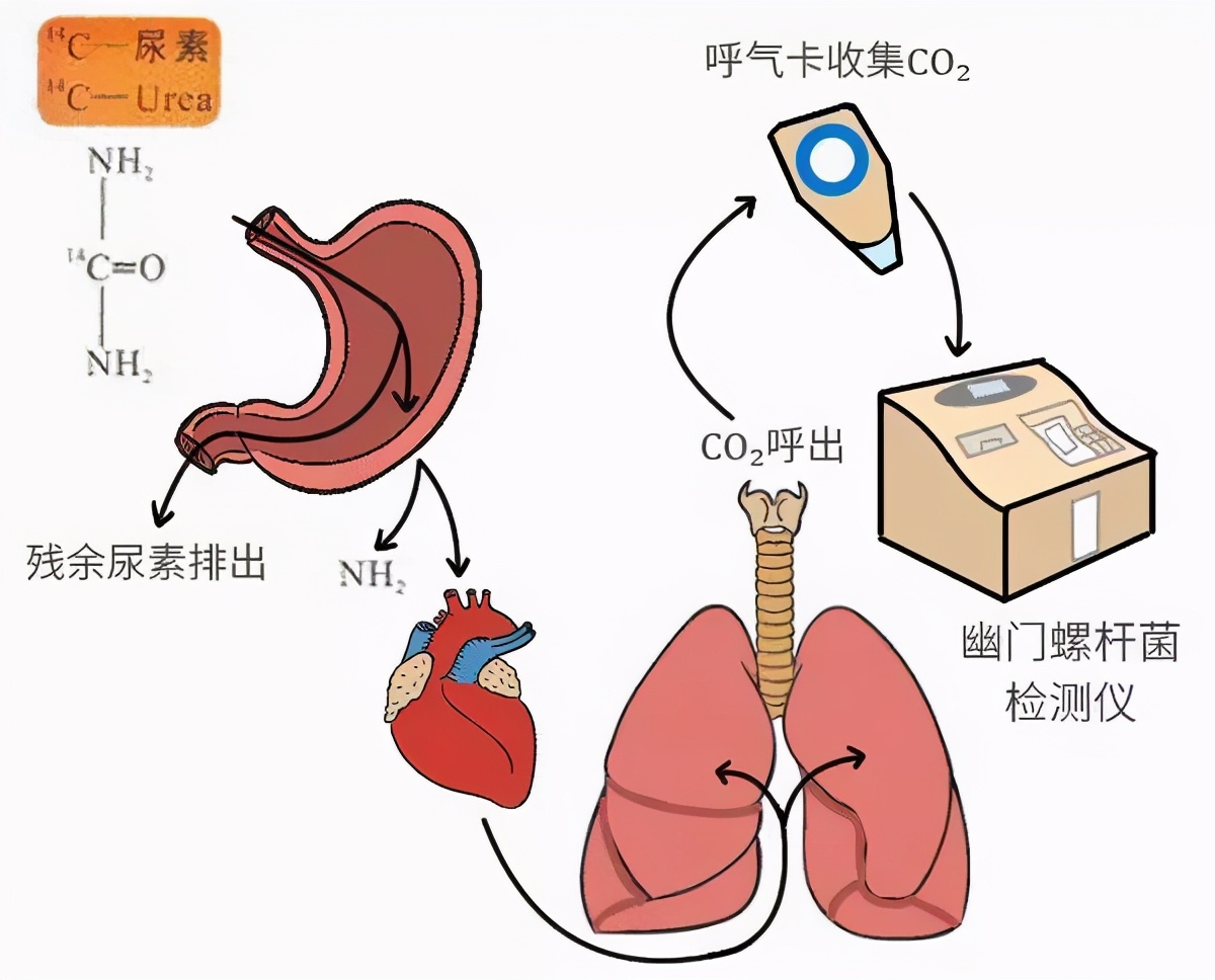 体检查幽门螺杆菌，呼气试验和抽血哪个更好？医生告诉你该怎么选