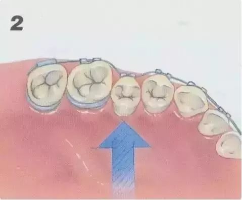 省钱选择“钢丝矫正”，这些你事情需要知晓