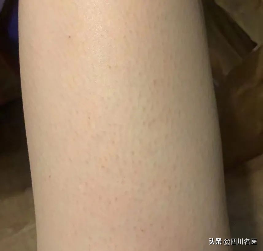 难看的“鸡皮肤”，到底还有没有救？华西皮肤科医生来支招