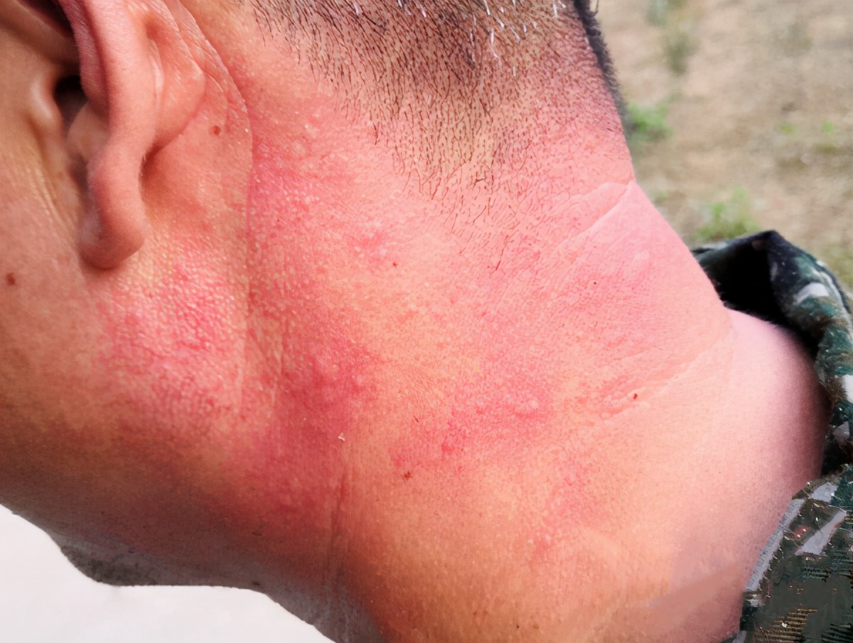 痱子成片成片地长,怎么都消不掉,权威专家:3个步骤快速改善