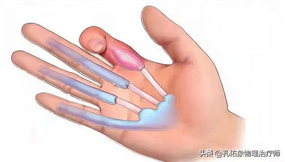 更年期女性极易遭受腱鞘炎的折磨，为什么？该如何治疗？