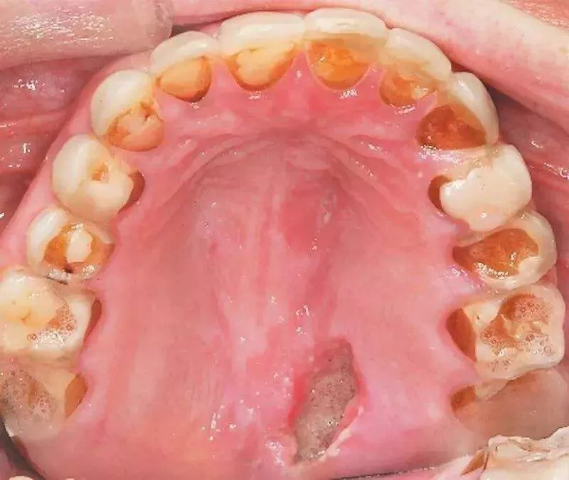 口腔或其他部位的溃疡
