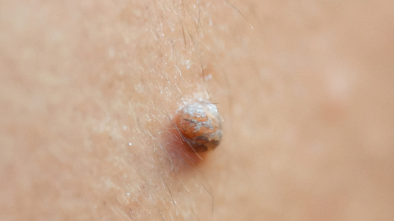 脖子和腋下的“小肉粒”是什么？可以用手直接扣掉吗？要引起重视