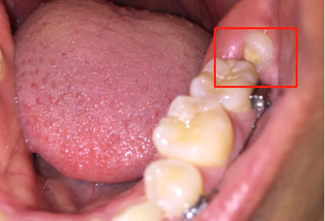 智齿发炎疼痛难忍,其实是冠周炎的问题,教你三招轻松缓解