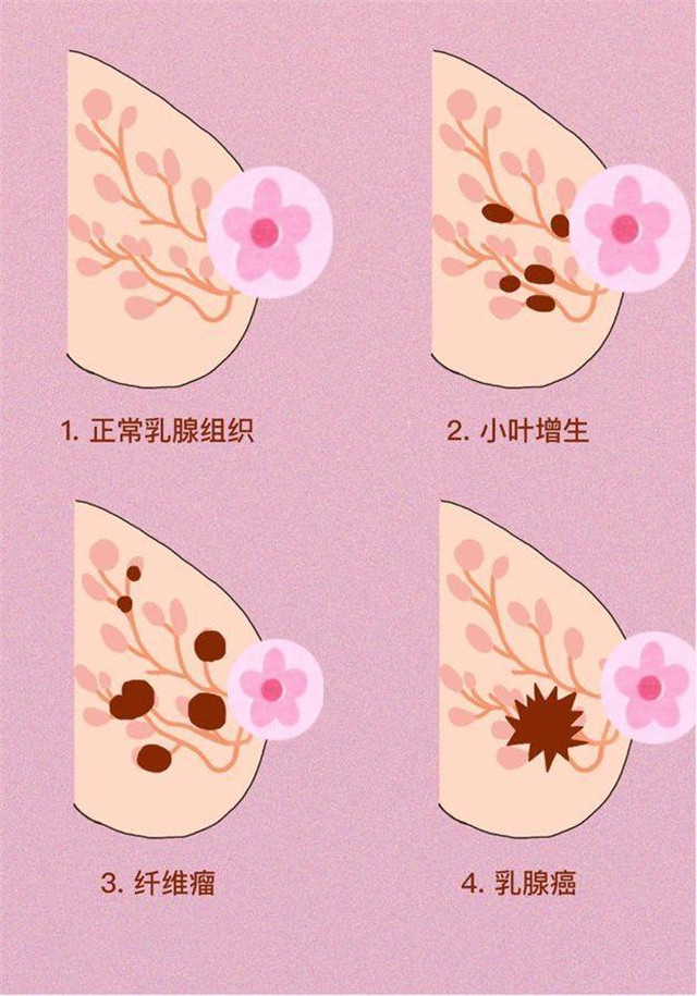 乳房表面红肿发炎图片(胸部肿痛) - 赤虎壹号