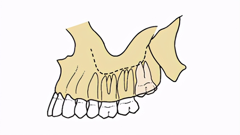 ①上颌智齿,难度系数:★★, 价格:普通上颌智齿如果没有其他的问题