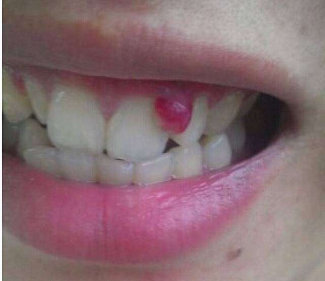 牙龈增生是怎么回事图片