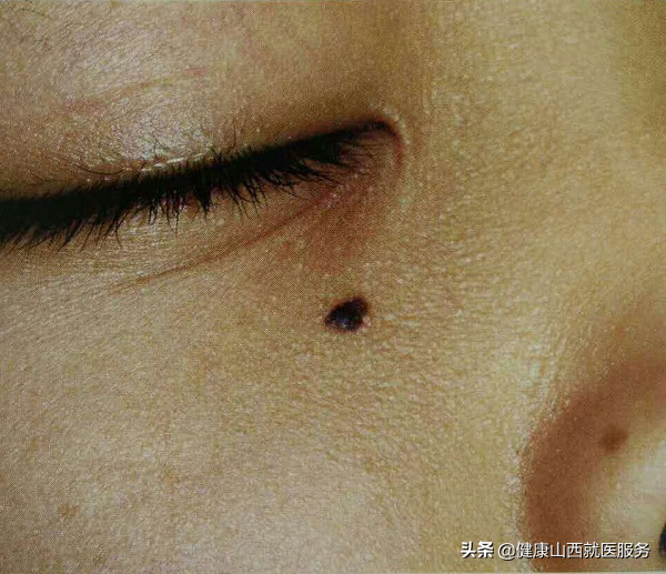 激光去痣价格表脸上的