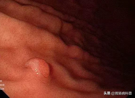 为啥会长胃息肉?会不会癌变?如何治疗和预防?