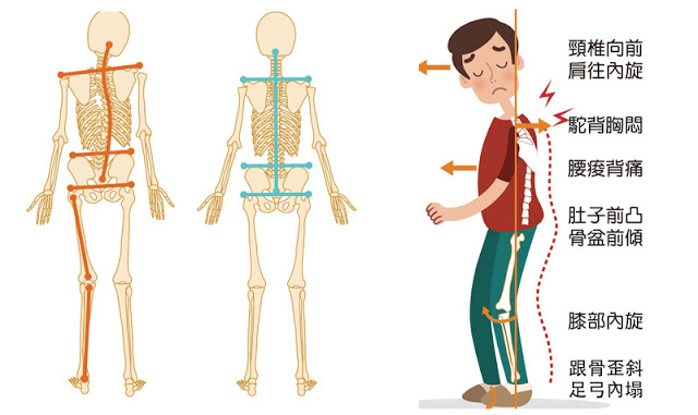 因为骨盆歪掉，所以常常腰酸背痛？如何改善，矫正有用吗？