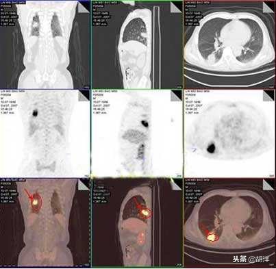 明明胸部CT上已经写了肺癌，为什么还要做那么多花钱又痛苦的检查