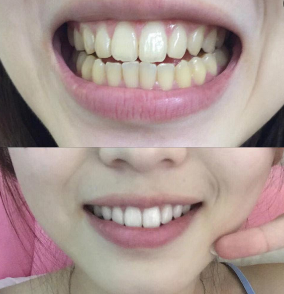 你知道“小巨蛋”吗？10s抗糖美白牙齿，效果比洗牙好太多了