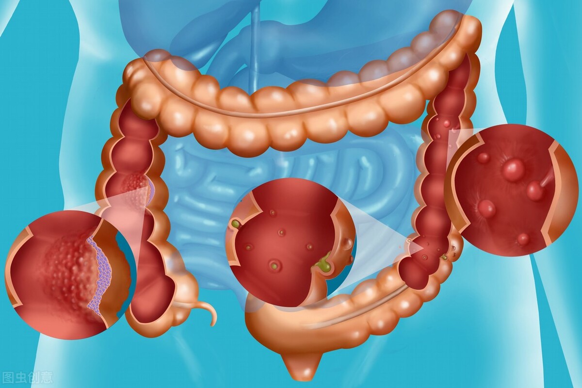 肠内若长了"息肉",身体会有什么症状反应?