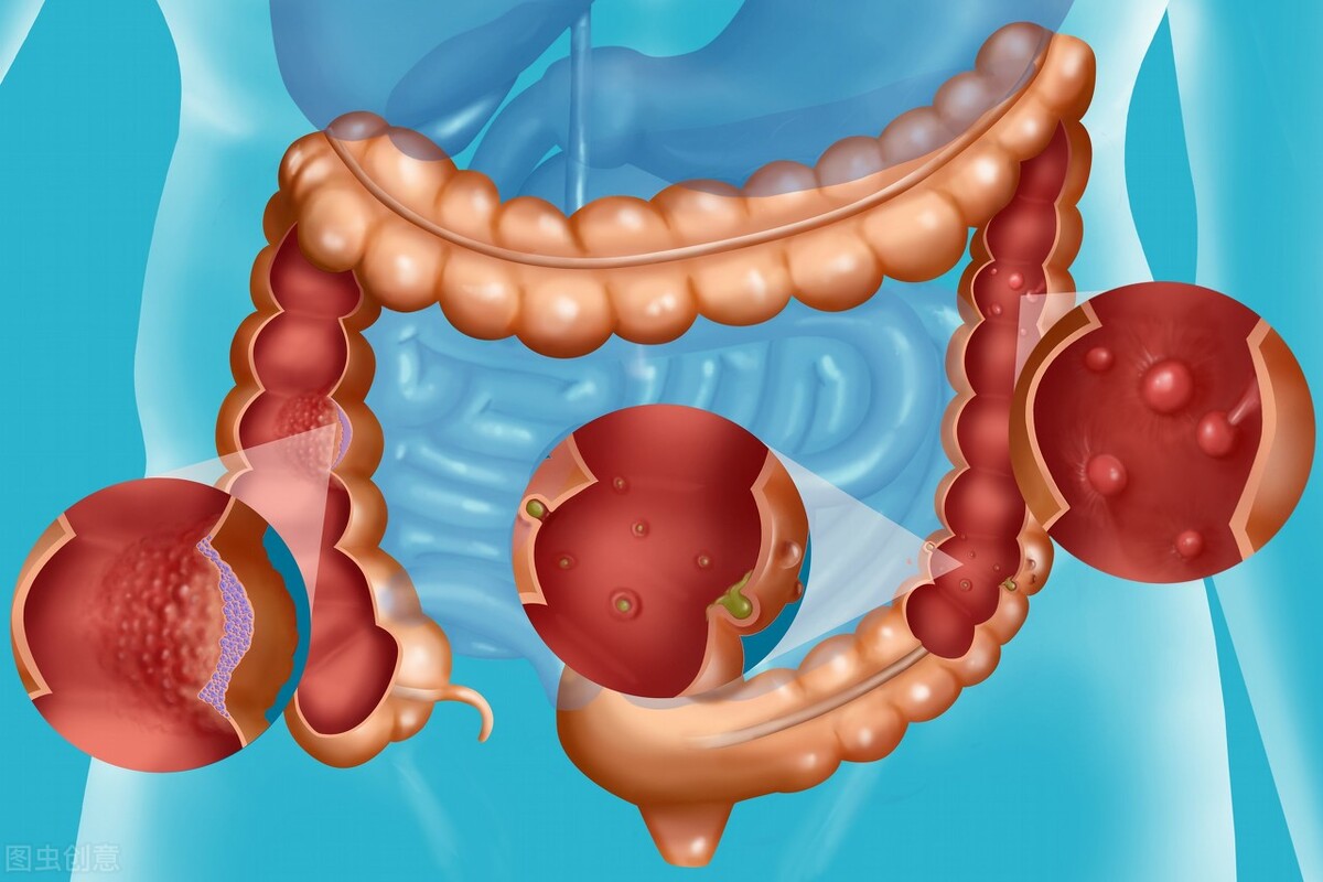 肠内若长了“息肉”，身体会有什么症状反应？