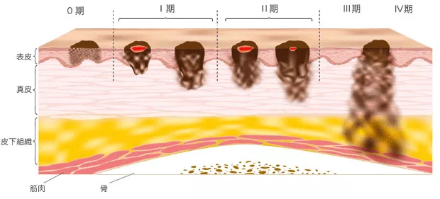 身上有这几种痣最好去点掉，尤其是长在隐秘部位的