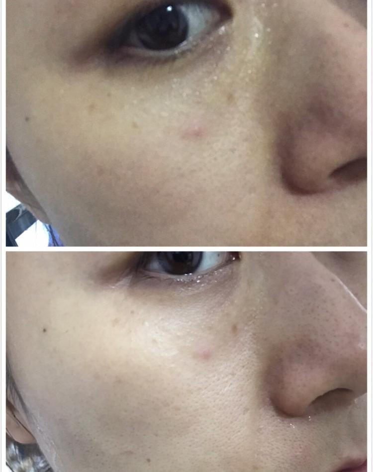 去角质是啥去角质是啥原理