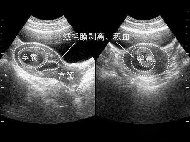 怀孕后出现宫腔积液是怎么回事？怀孕出现宫腔积液要注意什么?