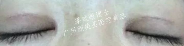 双眼皮修复之上睑”鼓鼓“的，为啥还要填脂肪？