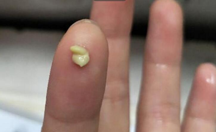 扁桃体结石|不规则的小颗粒,非常臭,还忍不住想闻?本文说清楚