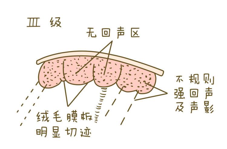 如何判断胎盘成熟度 怎么看胎盘发育得好不好