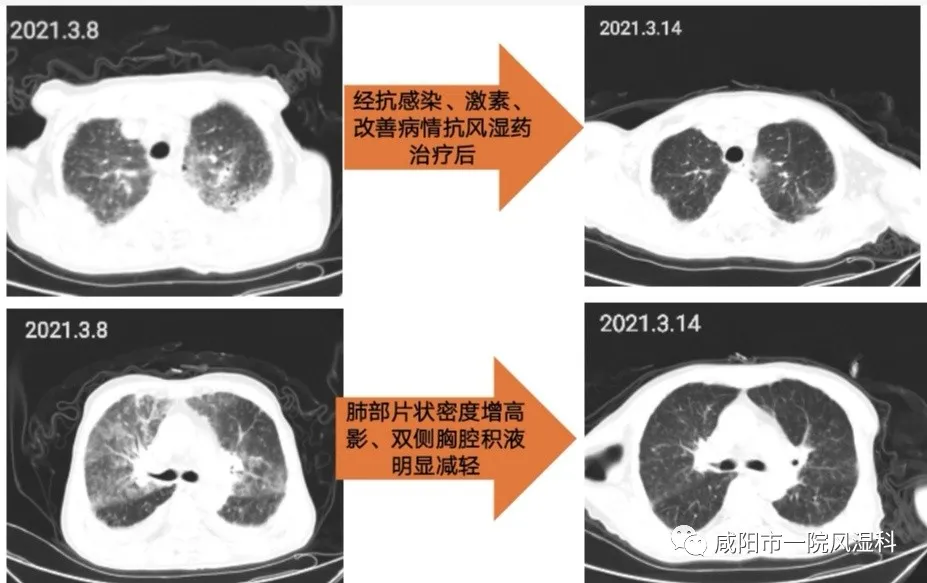 咸阳市第一人民医院:间质性肺炎病因不明?谨记排查风湿性疾病