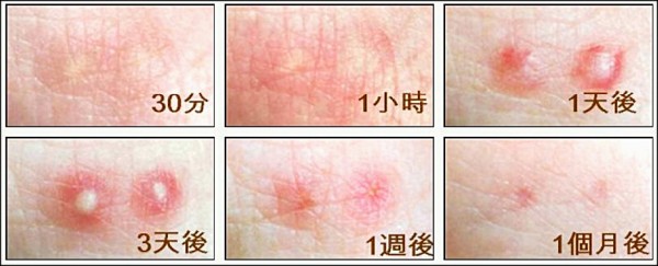 红火蚁又杀人了，广西一女子被咬后死亡！被其咬伤后该如何治疗？