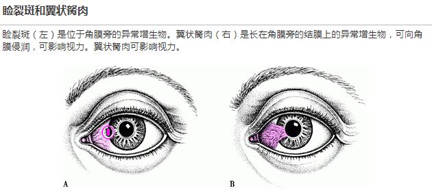 太阳晒久了眼睛上会长“翅膀”？眼磨的难受怎么办，一次说清楚