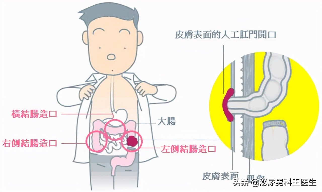 一个人没了肛门会怎样？我国“造口人”超百万，生存困境谁能懂？